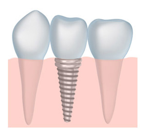 tooth implant dentistry in Derry NH and Manchester NH