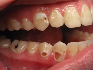 Decay caused from carbonated soda